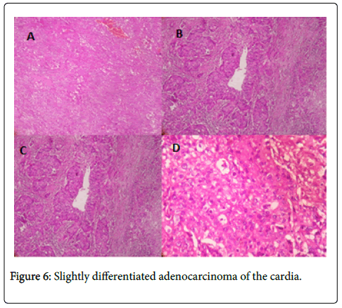 clinical-experimental-pathology-Slightly-differentiated