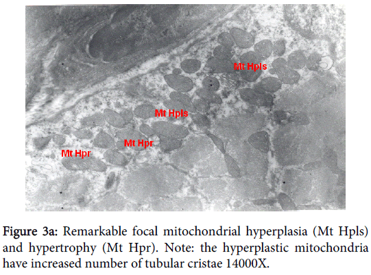 clinical-experimental-pathology-focal-mitochondrial-hyperplasia