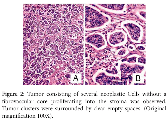 clinical-experimental-pathology-several-neoplastic-Cells