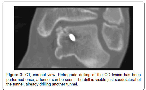 clinical-foot-ankle-drilling-tunnel