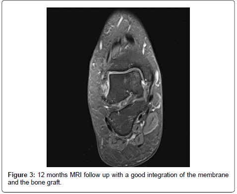 clinical-foot-ankle-membrane-bone