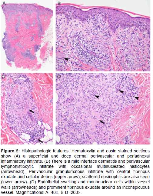 Granulomatous Syphilis: A Pattern to Remember. Case Report and Review ...