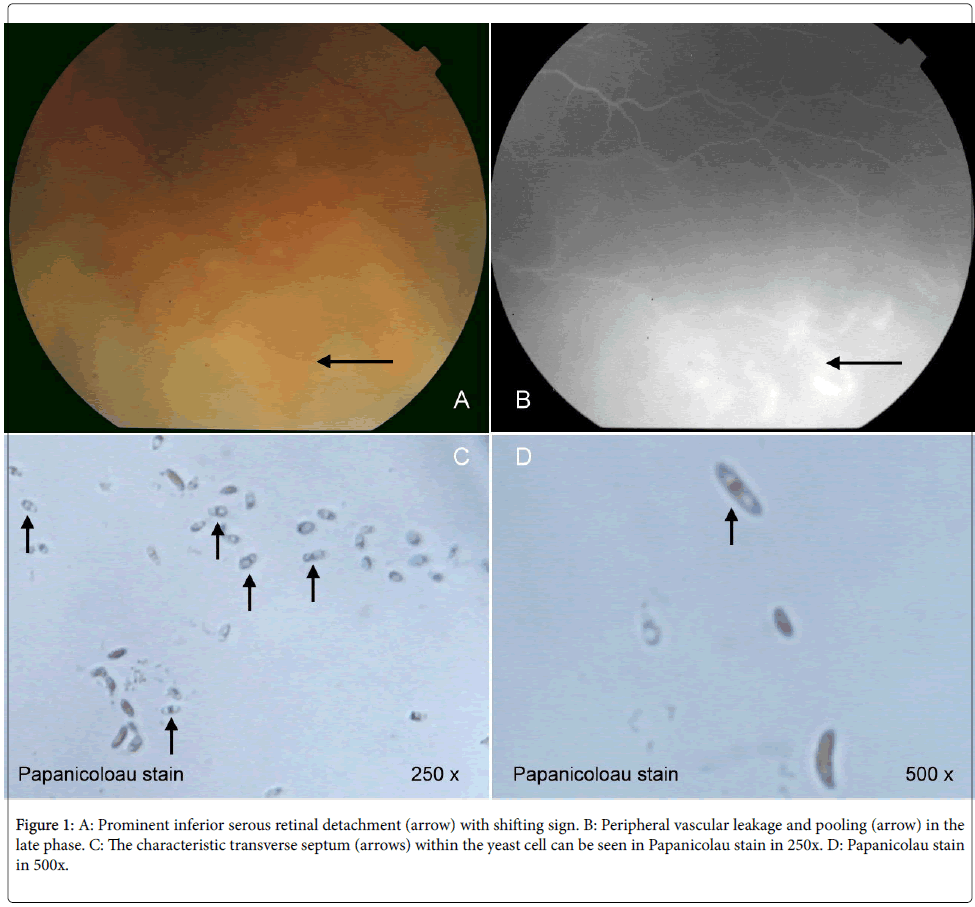 clinical-ophthalmology-retinal-yeast