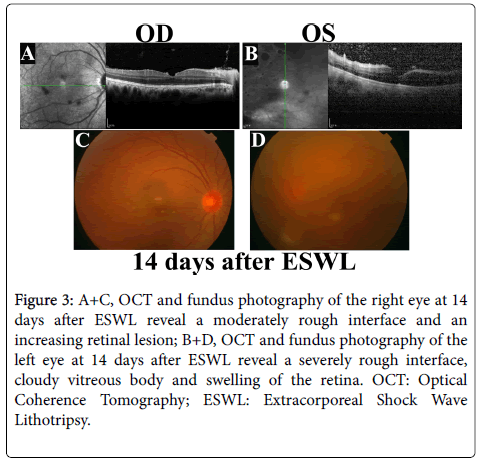 Clinical-ophthalmology-rough-interface