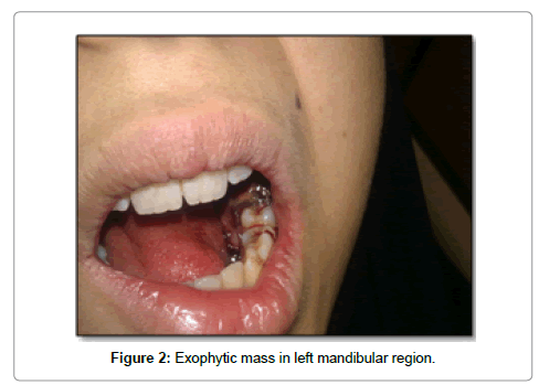 Dermatologic Complications of Dermabond after Orthopaedic Surgery