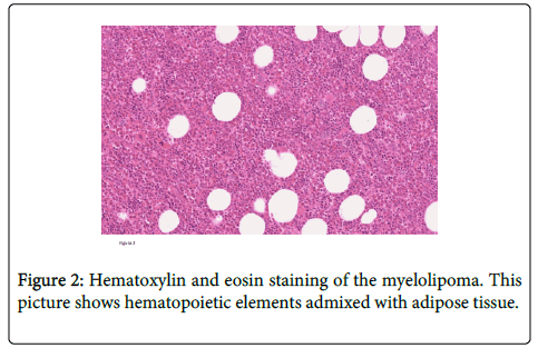 clinical-pathology-Hematoxylin-myelolipoma