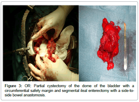 clinical-pathology-Partial-cystectomy