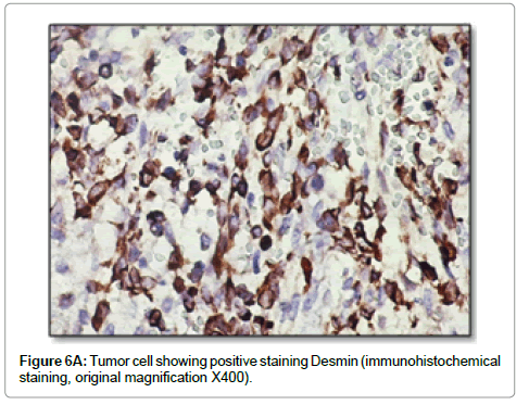 clinical-pathology-Tumor-cell