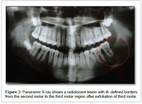 clinical-pathology-radiolucent-lesion