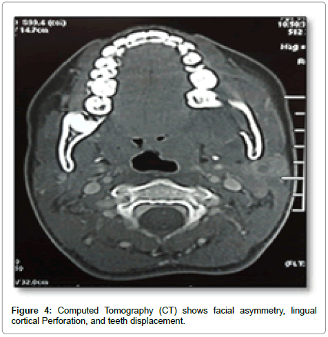 clinical-pathology-teeth-displacement