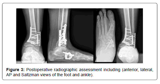 clinical-research-foot-Saltzman-views