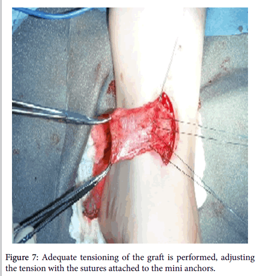 clinical-research-foot-ankle-Adequate-tensioning-graft