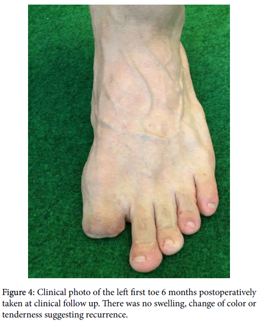 clinical-research-foot-ankle-Clinical-photo-left-first-toe