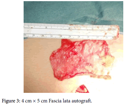 clinical-research-foot-ankle-Fascia-lata-autograft