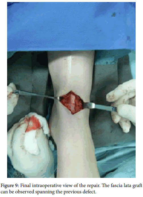 clinical-research-foot-ankle-Final-intraoperative-view-repair