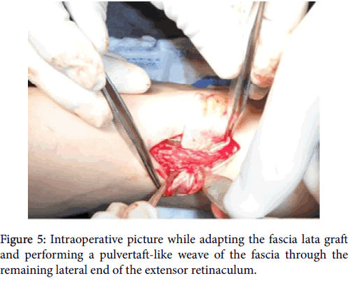 clinical-research-foot-ankle-Intraoperative-picture-adapting