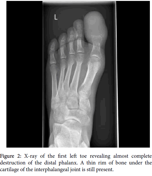 clinical-research-foot-ankle-first-left-toe