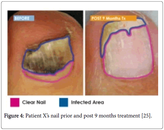 clinical-research-foot-ankle-nail-prior