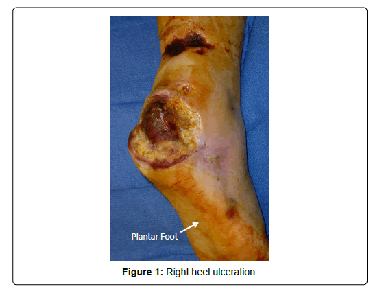 clinical-research-foot-anterior-Right-heel-ulceration