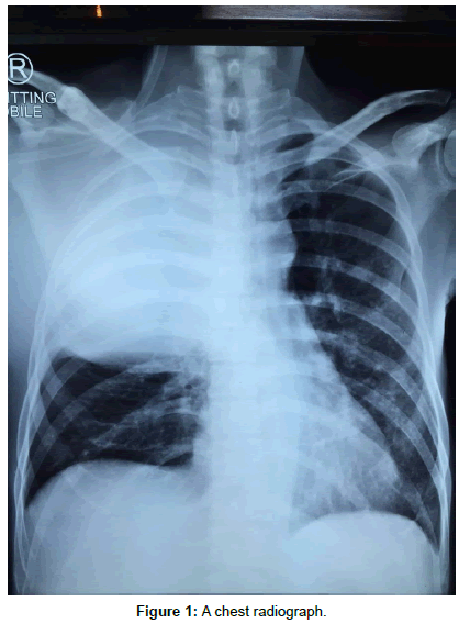 A Middle-Aged Man with Right-Sided Chest Pain, Hemoptysis and Weight ...