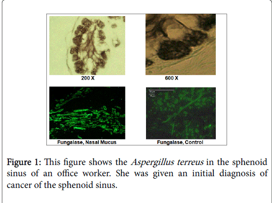 community-public-health-Aspergillus-terreus