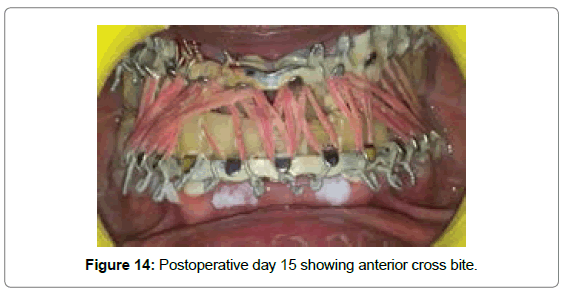 cosmetology-orofacial-surgery-anterior-cross-bite