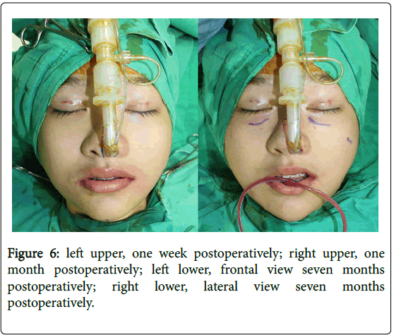 cosmetology-orofacial-surgery-week-postoperatively