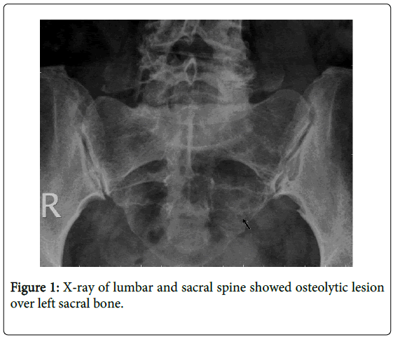 Low Back Pain Radiating to the Left Buttock as a Form of Onset of ...