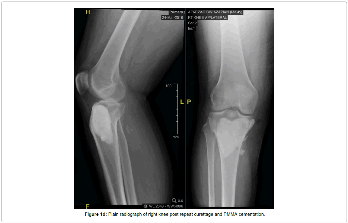 currentissue-orthopedic-oncology-right-knee
