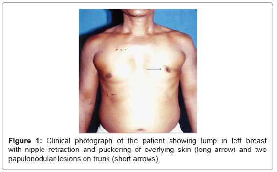 multiple-remote-cutaneous-metastases-from-male-breast-carcinoma