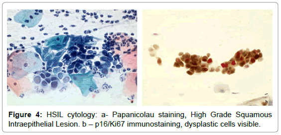 cytology-histology-hsil-cytology