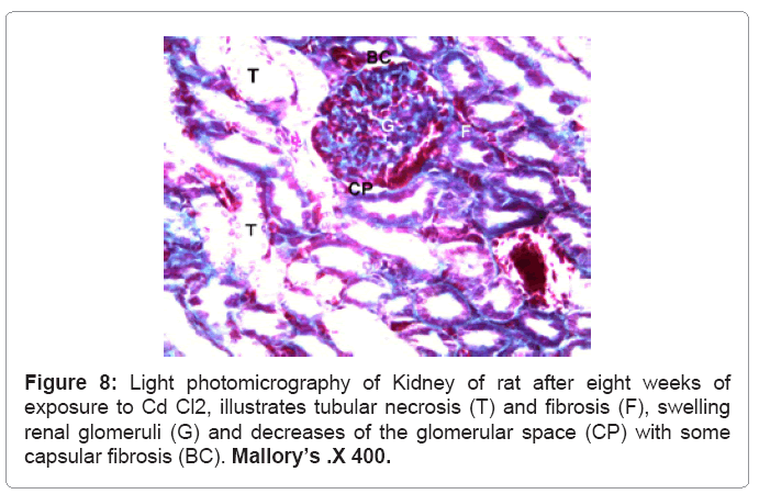 Acute Tubular Necrosis Histology