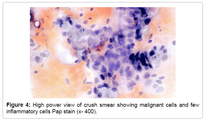 cytology-histology-inflammatory-cells