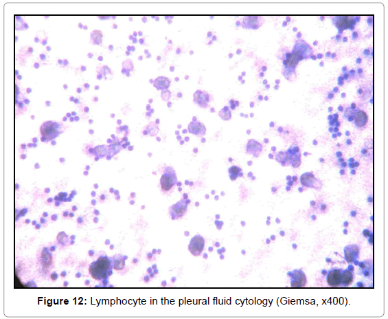 cytology-histology-lymphocyte-pleural-giemsa-x400