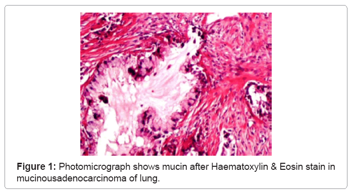 Mucin Histochemistry in Tumours of Colon, Ovaries and Lung | OMICS ...