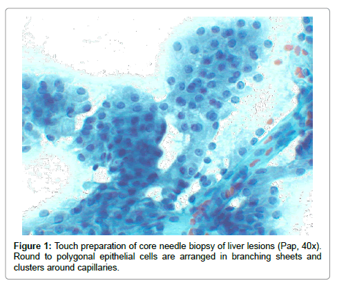 Acinic Cell Carcinoma Histology