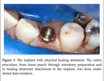 dental-implants-attached-healing