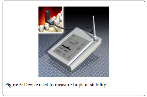 dental-implants-dentures-Device-measure-Implant