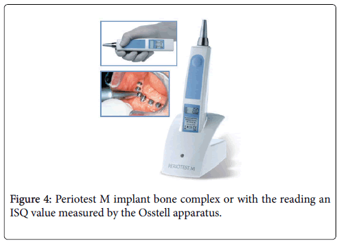 dental-implants-dentures-Periotest-M-implant-bone