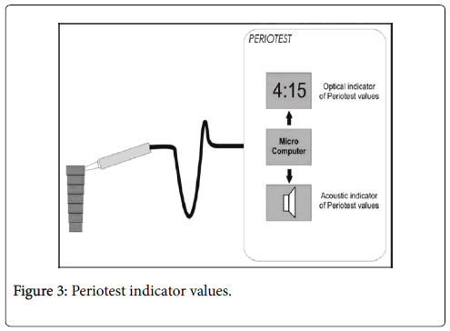 dental-implants-dentures-Periotest-indicator-values