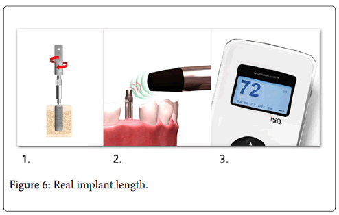 dental-implants-dentures-Real-implant-length