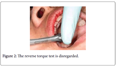 dental-implants-dentures-The-reverse-torque-test