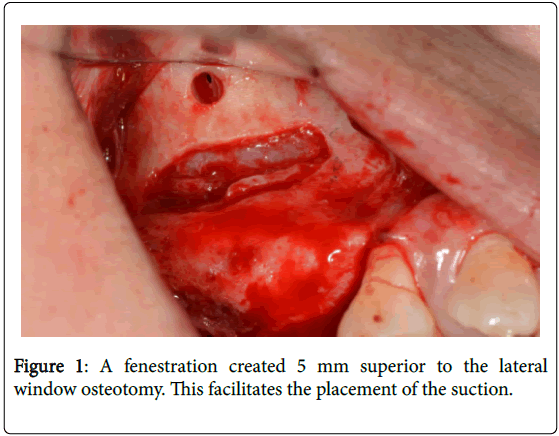 dental-implants-dentures-a-fenestration-created