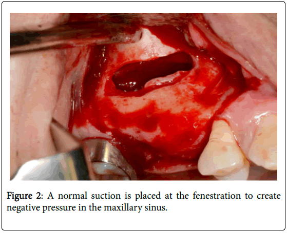 dental-implants-dentures-a-normal-suction