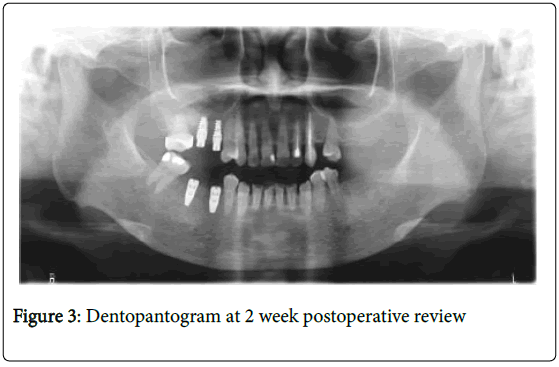 dental-implants-dentures-dentopantogram-2-week