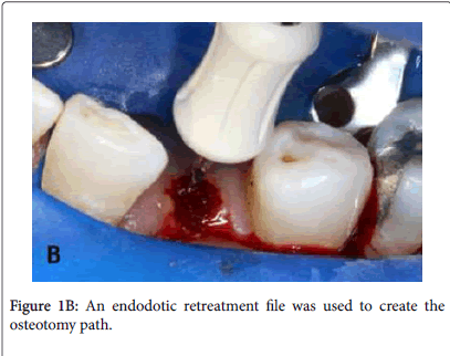 dental-implants-endodotic-retreatment
