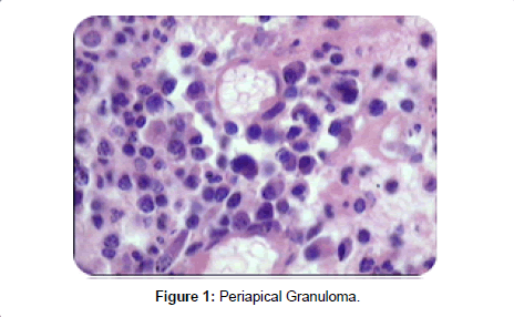 dentistry-Periapical-Granuloma