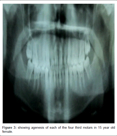 Radiographic Evaluation of Developmental Stages of Third Molar in ...