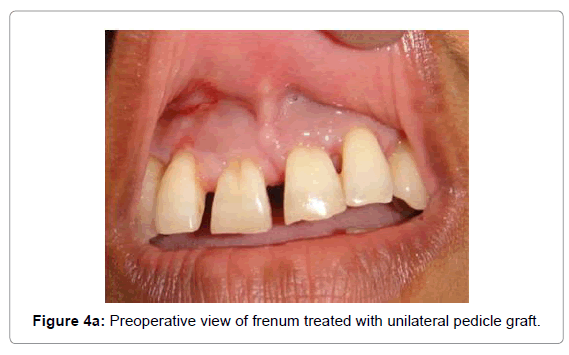 Comparative Results Of Frenectomy By Three Surgical Techniques