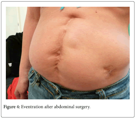 abdominal syndrome surgery danlos ehlers eventration figure after patients frequent victim whose rarely often